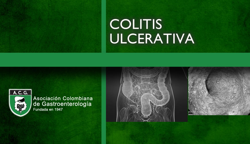 Colitis ulcerativa