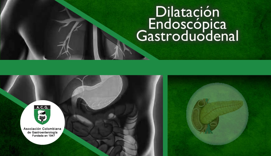 Dilatación Endoscópica Gastro Duodenal 